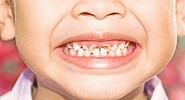 تسوس الأسنان عند الأطفال