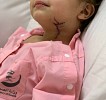 Tabuk Surgeons save 2-year-old from fatal glass table wound 