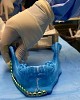  جراحو تبوك يعيدوا بناء فك مريض بطباعة ثلاثية الأبعاد 